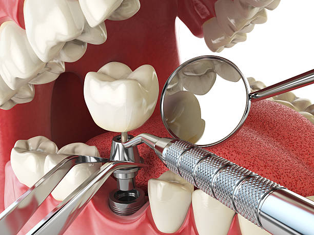 Best Emergency Dental Care for Sports Injuries in Meadowlakes, TX